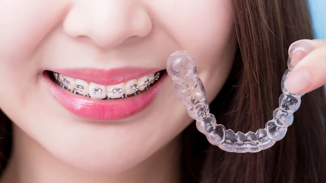 Braces vs. Invisalign: Comparing Orthodontic Options for a Perfect